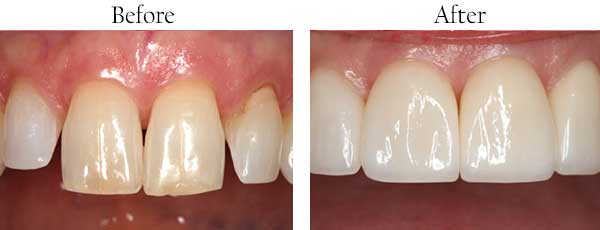 Before and After Dental Gallery Rancho Mission Viejo