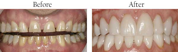 Before and After Dental Gallery 92694
