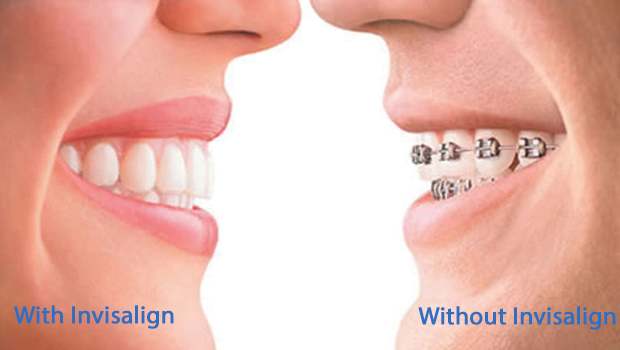 Invisalign in Ladera Ranch